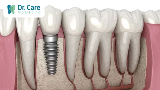 Khắc phục tình trạng mất răng do lấy tủy trước khi bọc răng sứ