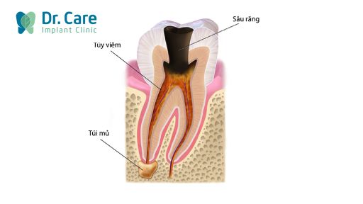 Nguyên nhân cần thực hiện chữa tủy răng