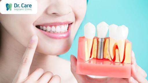 Khắc phục trường hợp mất răng do răng sứ bị hư bằng cấy ghép Implant