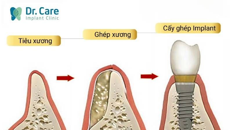 3 trường hợp cần ghép xương răng?