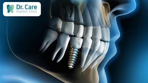 Trồng răng Implant là gì?