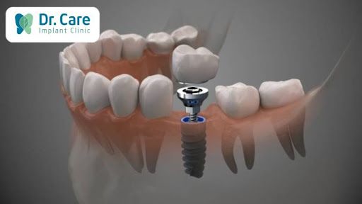 Niềng răng thất bại trồng răng implant được không? 