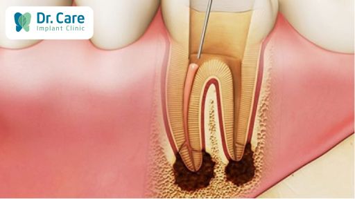 Những trường hợp cần lấy tủy răng