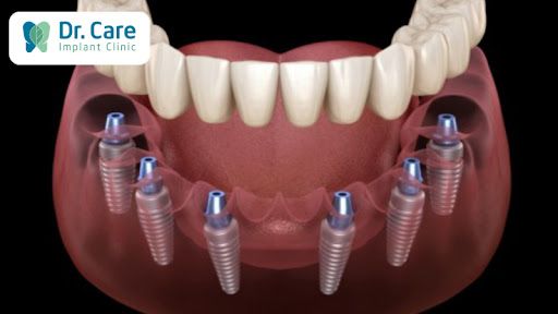 Cấy ghép Implant toàn hàm All on 6