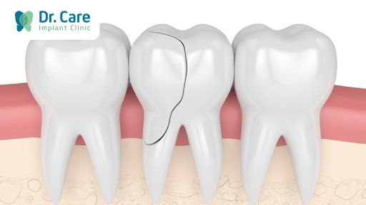 Răng bị nứt có nguy hiểm không? 