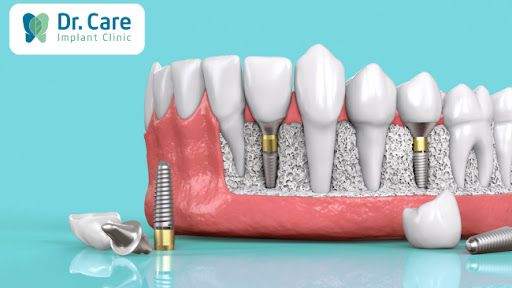 Trồng răng Implant - giải pháp phục hồi răng bị mất hiệu quả