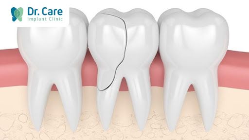 Nứt dọc thân răng là gì?