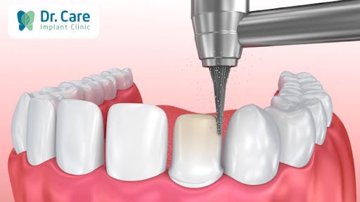 Bọc răng sứ thẩm mỹ có tác động đến răng thật không?