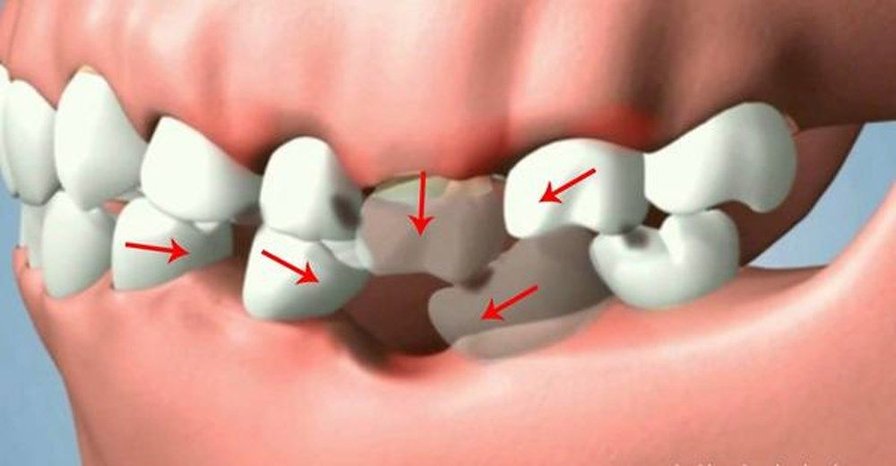 Trường hợp niềng răng thất bại