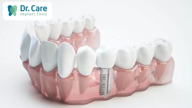 Phục hồi răng đã mất sau khi nhổ răng bằng phương pháp trồng răng Implant