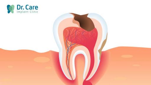 Viêm tủy răng số 7 là gì?