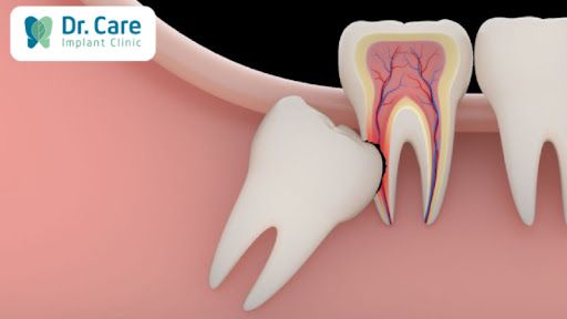 Răng khôn mọc sai vị trí có ảnh hưởng gì không?