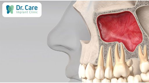 Mất răng lâu năm, hạ xoang hàm có gây viêm xoang không? 