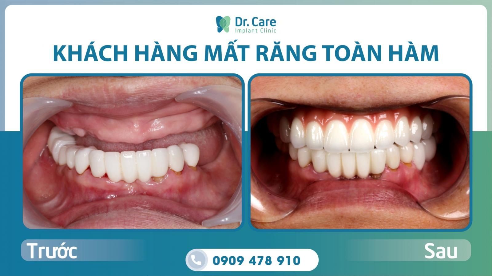 Chi phí trồng răng Implant toàn hàm tại Dr. Care