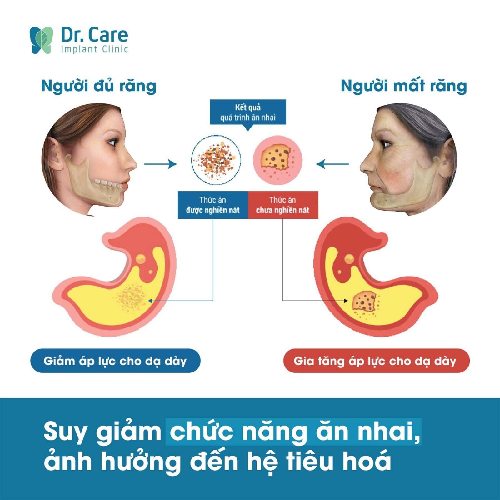 7 Nguy hiểm phải đối mặt khi mất răng toàn hàm