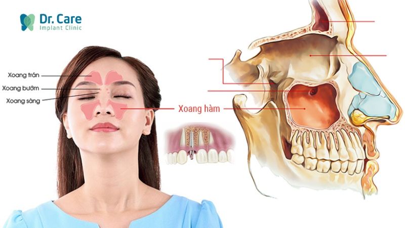 Trồng răng Implant hàm trên có nguy hiểm không?