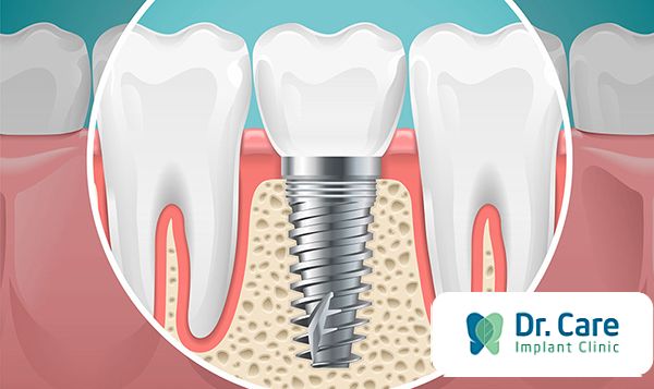 So sánh chi phí trụ Implant Alphadent với những dòng Implant khác