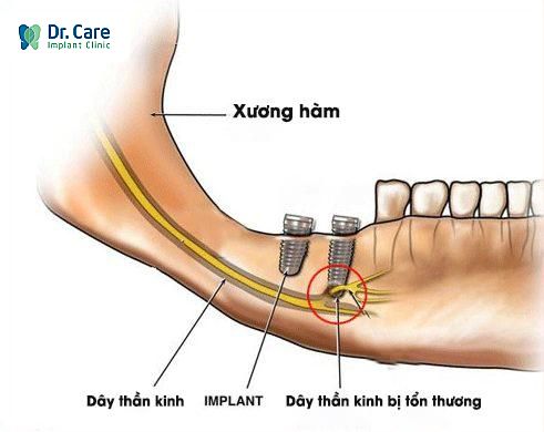 Gây tổn thương dây thần kinh răng dưới