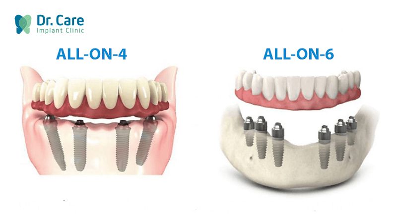 Kỹ thuật trồng răng Implant toàn hàm là gì?