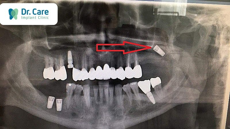 Sai lệch vị trí cắm Implant 