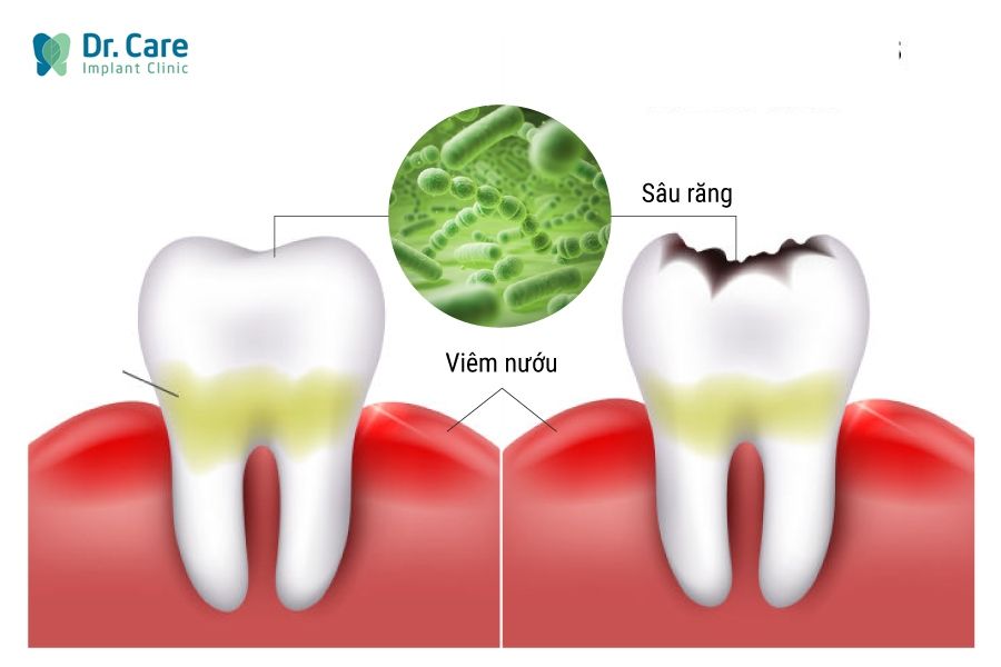 Nguyên nhân gây ra tình trạng mất răng toàn hàm