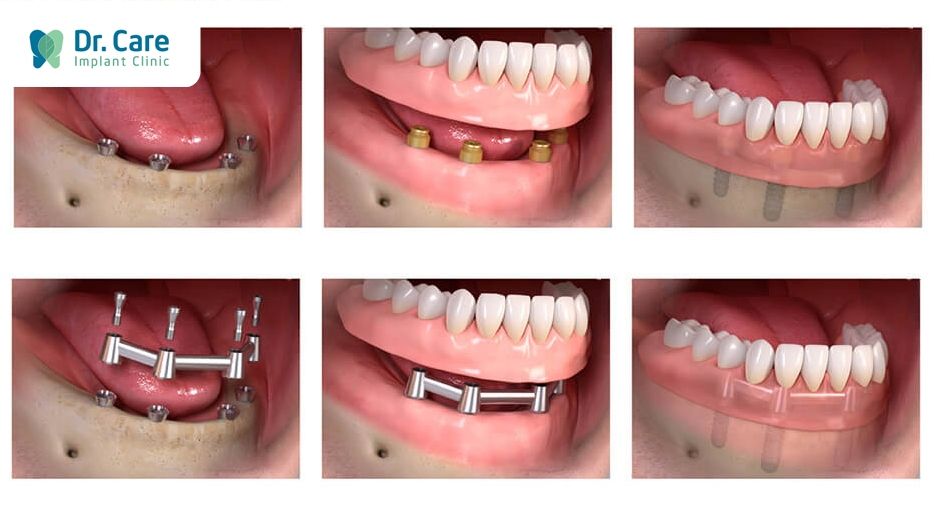 Trồng răng Implant - biện pháp phục hình mất răng toàn hàm hiệu quả nhất