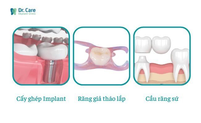 Mất răng số 7 hàm trên/ dưới trồng lại được không?