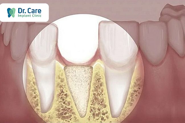 Các loại tiêu xương hàm dưới thường gặp 