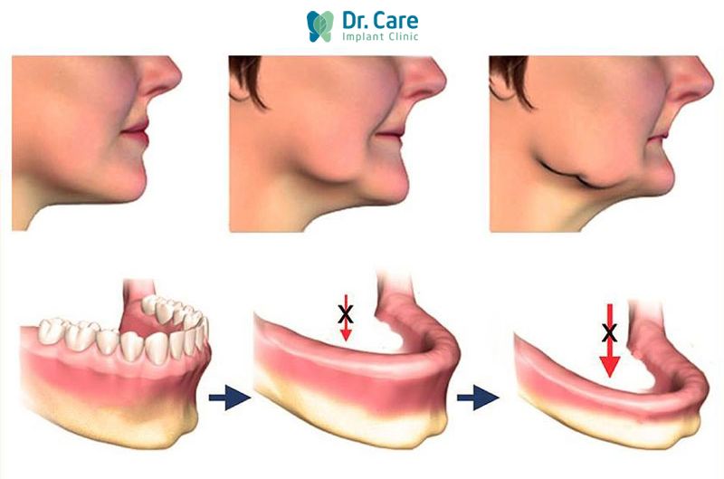 4 Hậu quả của việc tiêu xương hàm dưới 