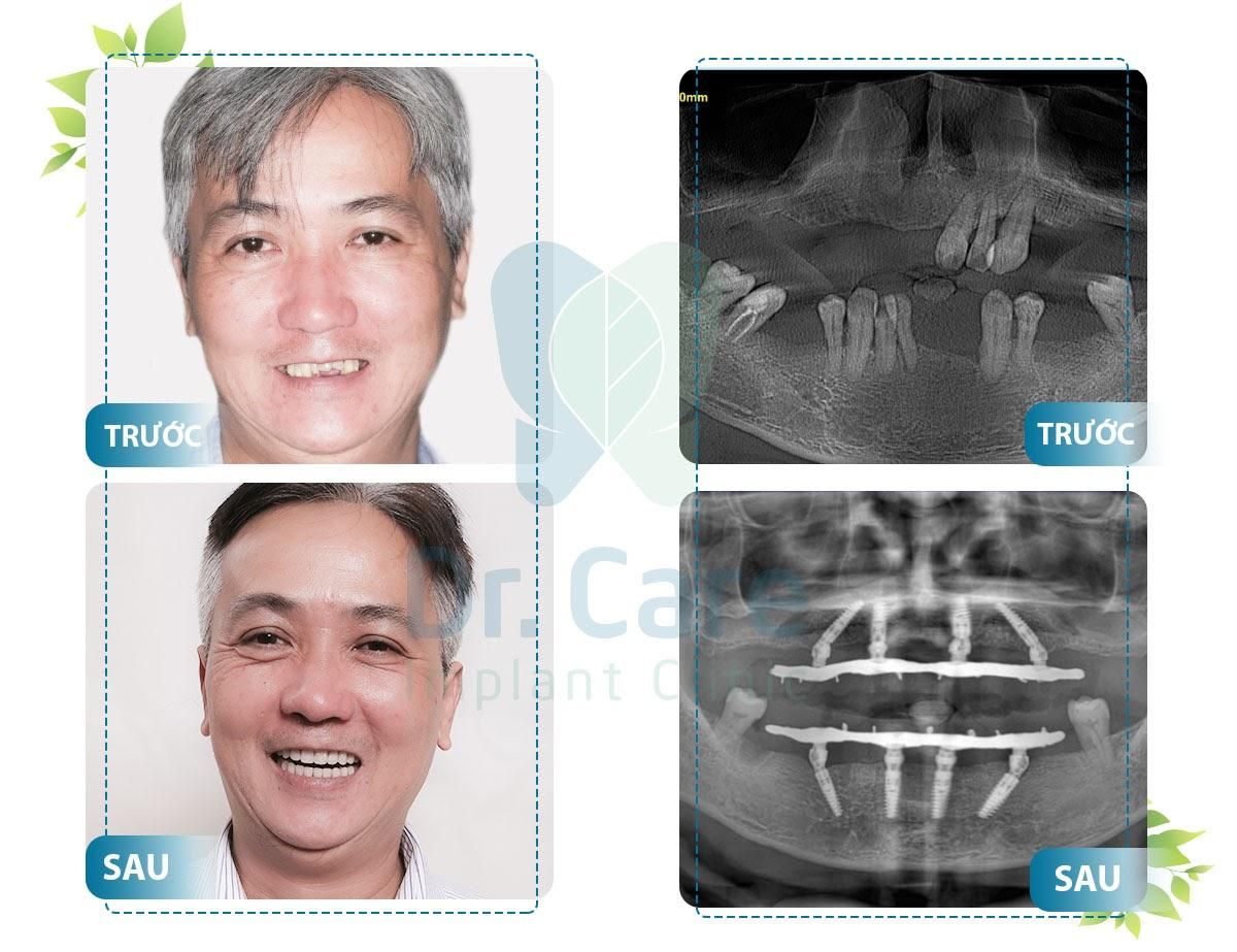 Trồng răng Implant - phương pháp ngăn chặn tiêu xương hàm dưới 