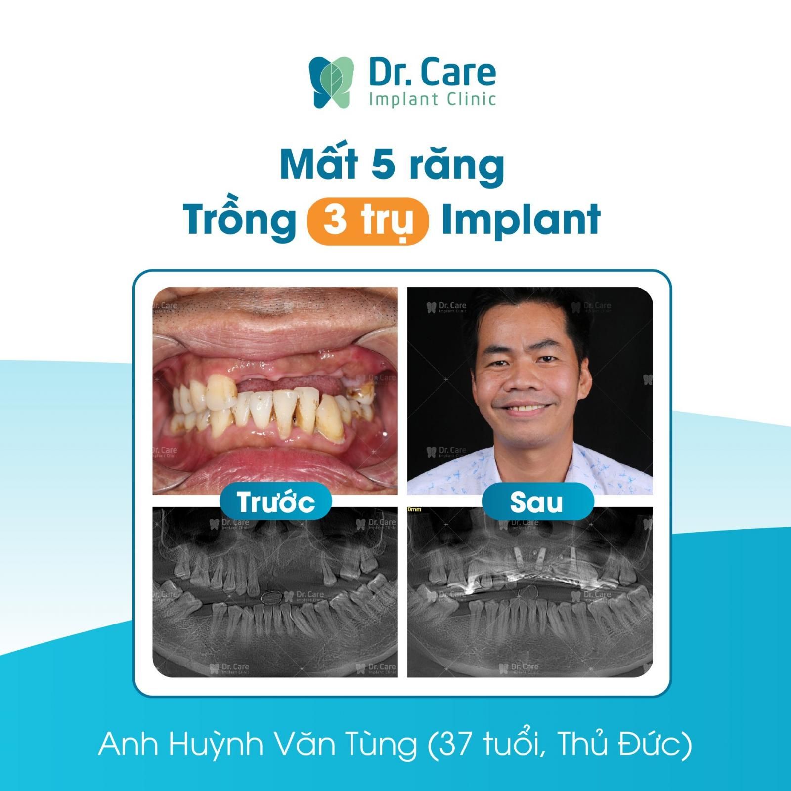 Vì sao chi phí trồng răng Implant lại nhỉnh hơn các phương pháp khác?