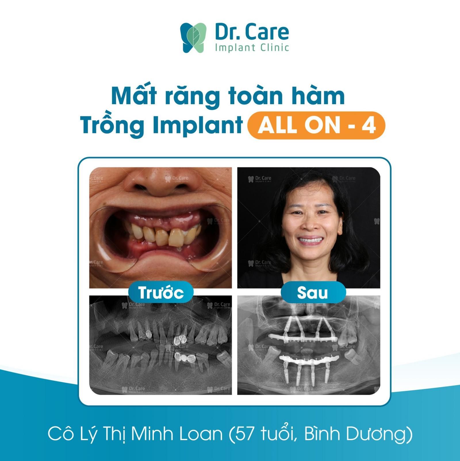 Vì sao nên chọn trồng răng Implant trả góp?