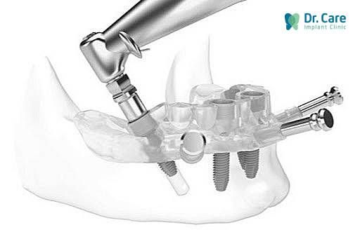 2 Nhược điểm của trụ Implant ICX Đức