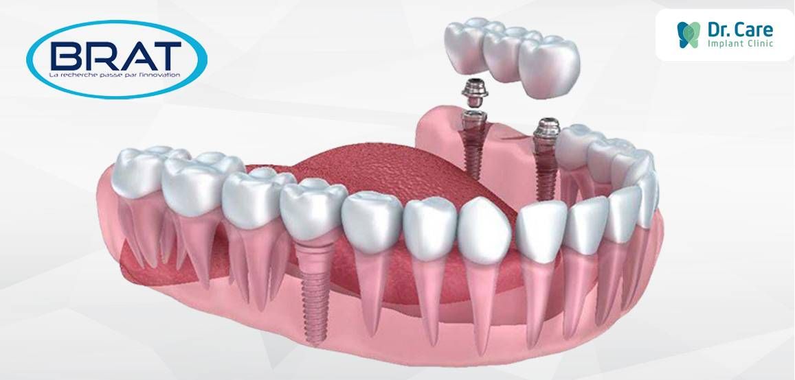 Trồng Implant Brat Pháp giá bao nhiêu?