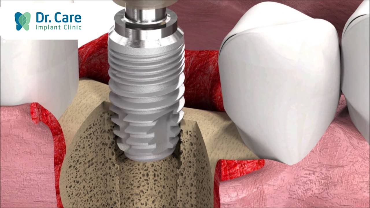 4 Ưu điểm của trụ Implant SIC