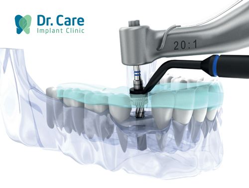 3 Nhược điểm của trụ Implant SIC