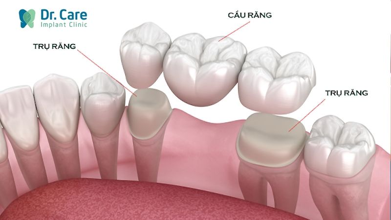 Cầu răng sứ là gì? 