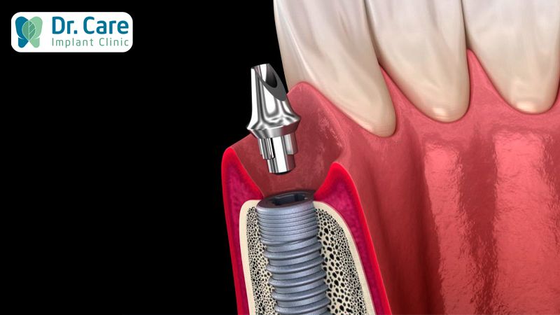 Rớt Custom Abutment nguy hiểm, gây đau nhức, ăn nhai khó khăn