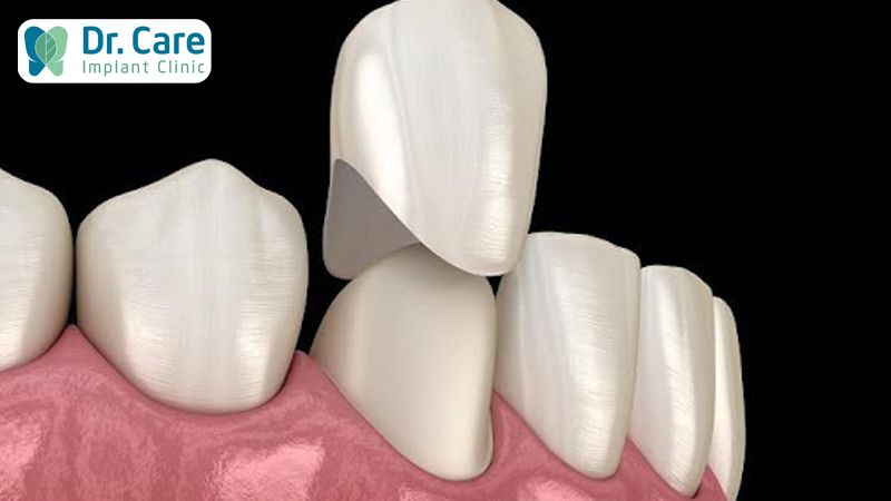 Có nên bọc răng sứ Zirconia?