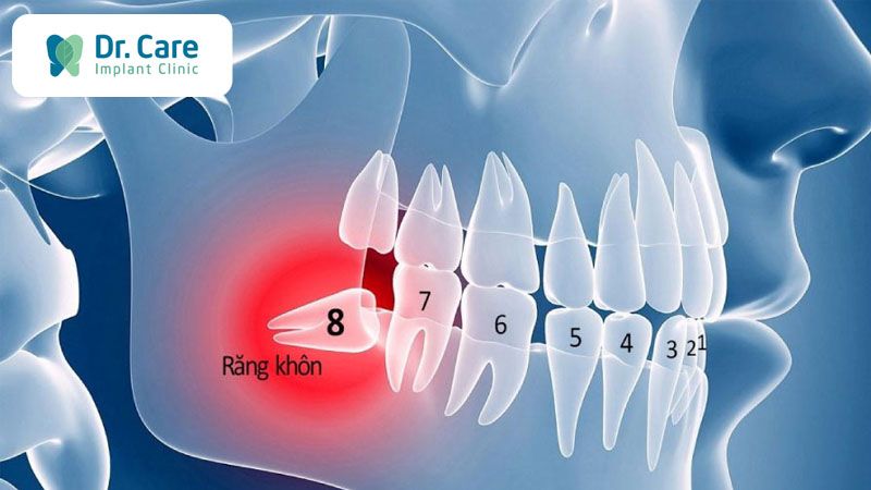 Đau răng do mọc răng khôn