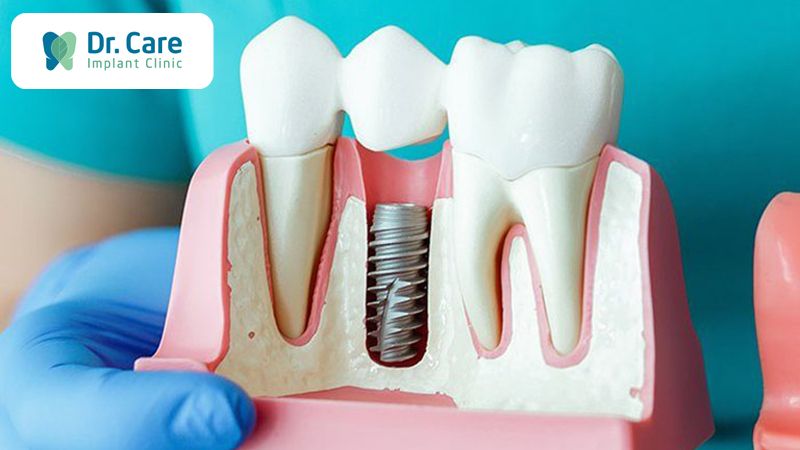 Có nên sử dụng thuốc tê chứa chất co mạch cho người cao huyết áp khi điều trị Implant?