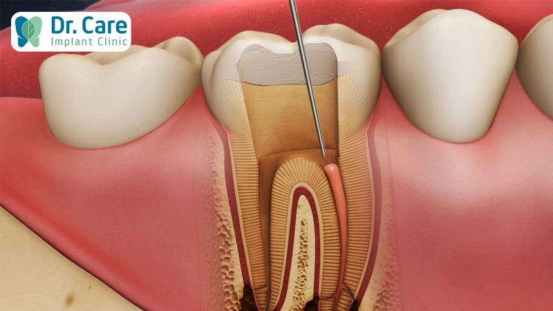 Lấy tủy răng là gì?