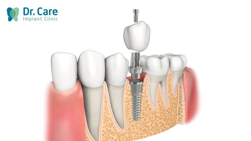 Mất răng do răng bị chết tủy có trồng lại được không? 