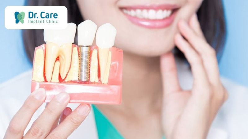 Chi phí trồng răng Implant có đắt không?