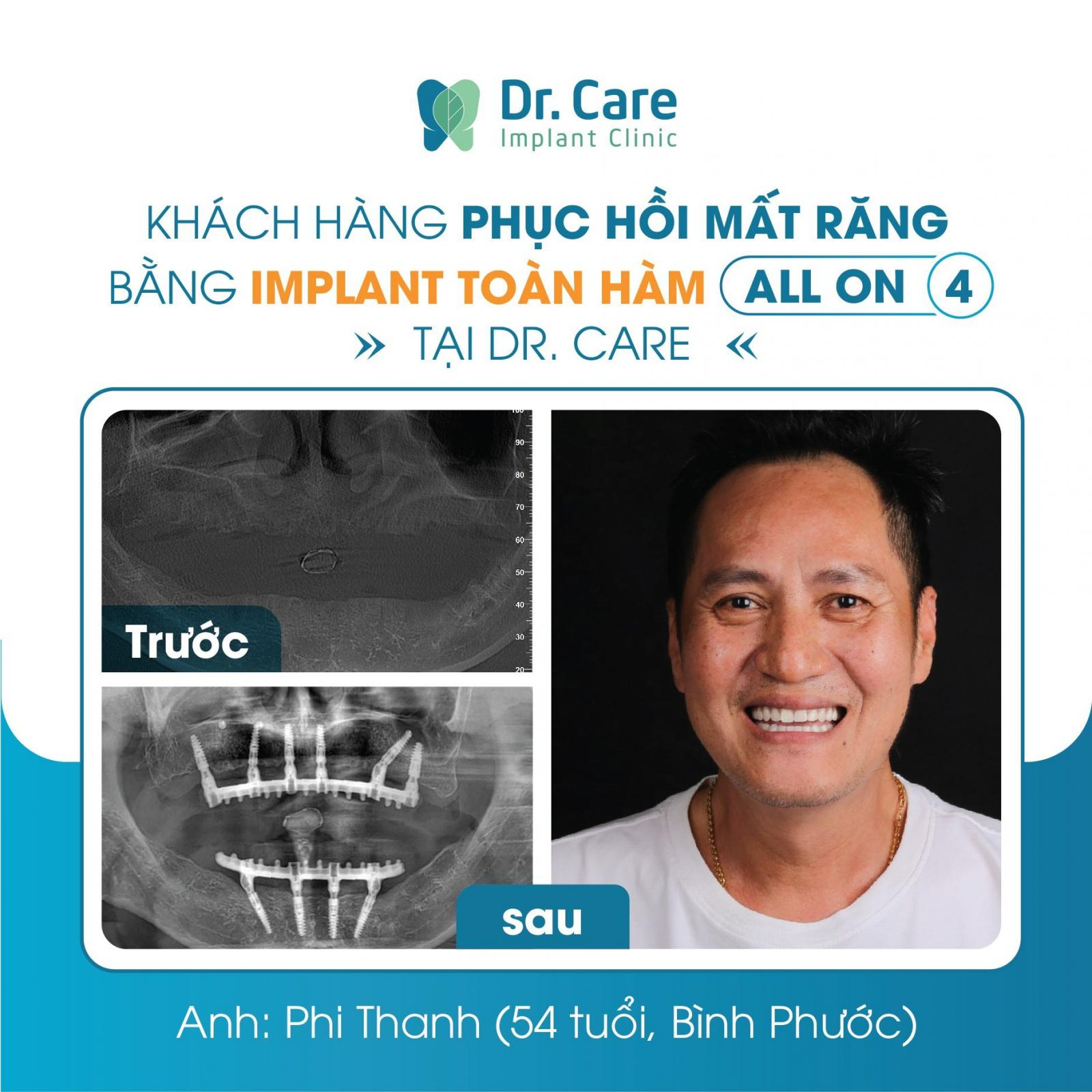 Trồng răng Implant - phương pháp phục hồi tiên tiến nhất 