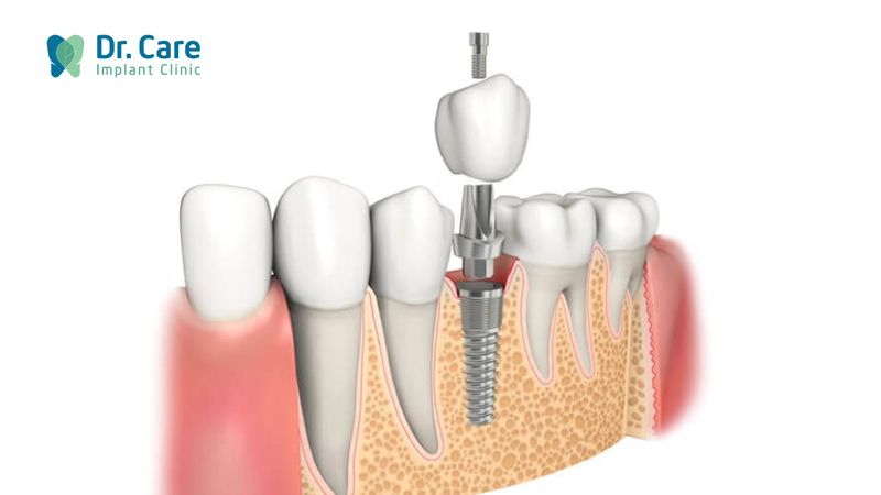 Điều trị nhiễm khuẩn răng mức độ nặng