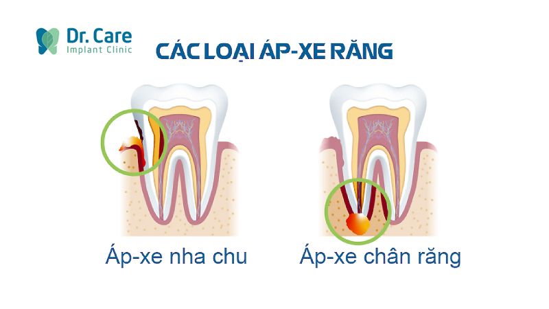 Tăng nguy cơ tử vong do nhiễm khuẩn răng miệng 