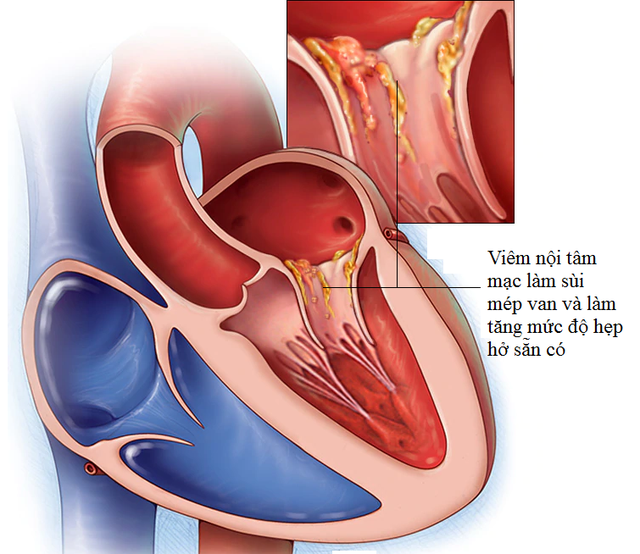  Viêm nội tâm mạc nhiễm trùng