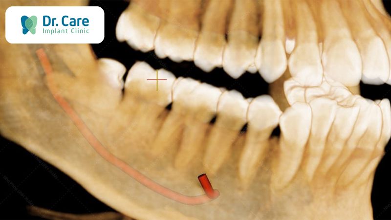 Ảnh hưởng của nhức răng kinh khủng tới hệ thần kinh