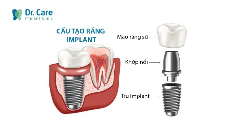 Cấu tạo tương tự răng thật